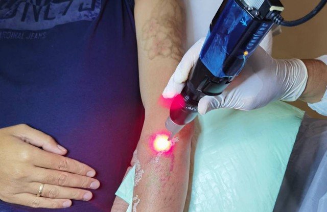 Treatment menghilangkan tato dengan laser. Foto-foto: Dok. Surabaya Skin Centre