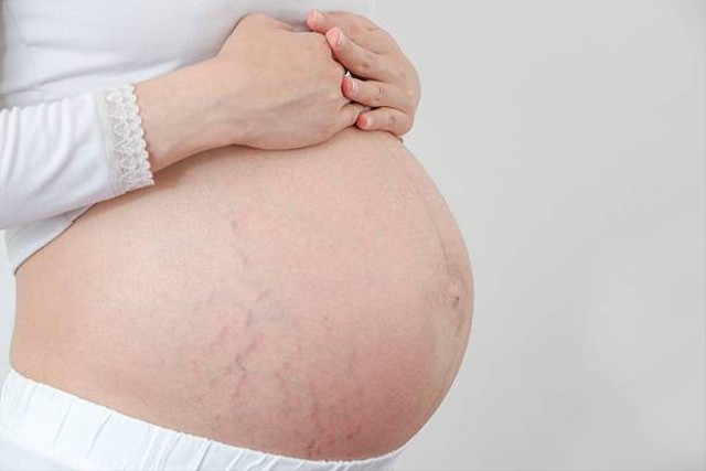 Ilustrasi apakah stretch mark bisa hilang (Sumber: Pexels)