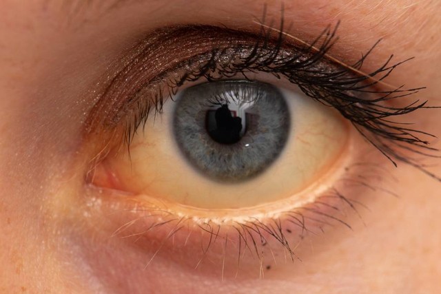 Salah satu gejala terinfeksi hepatitis A adalah warna mata yang menjadi kuning. Foto: Shutterstock