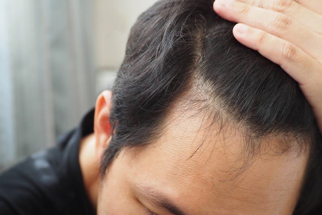 Ilustrasi rambut menipis. Foto: Shutterstock