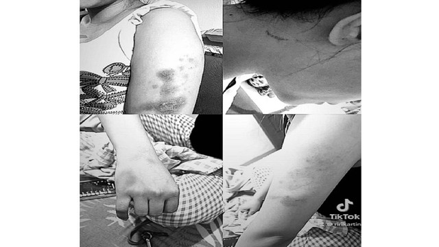 Luka memar diperlihatkan korban akibat penganiayaan diduga dilakukan oknum polwan dan ibunya (Tangkapan Layar/Instagram/@ririapriliaaaaa)