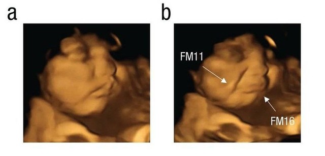 Gambar dari studi FETAP (Fetal Taste Preferences) ini menunjukkan janin 'meringis' di sebelah kanan, sebagai reaksi terhadap rasa kangkung.