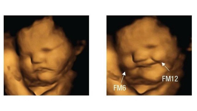 Reaksi janin yang tampak tersenyum, difoto 20 menit setelah ibu-ibu mengonsumsi kapsul berisi bubuk wortel.