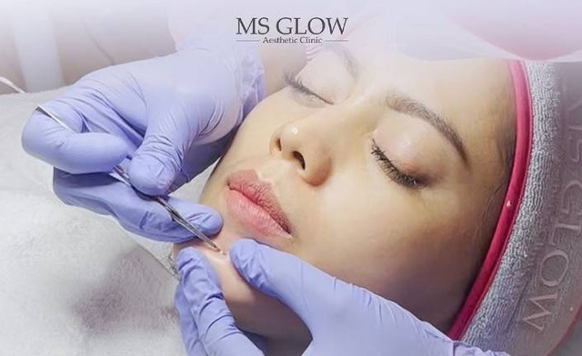 Salah satu treatment di MS Glow Clinic Yogyakarta. Foto: Instagram/@msglowclinicyogya