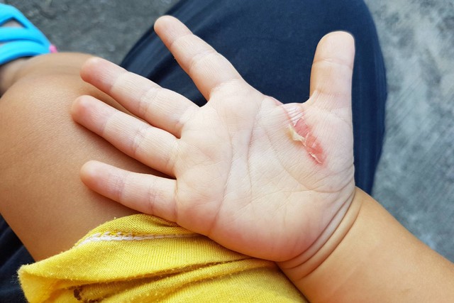 Ilustrasi luka bakar pada anak.  Foto: NikomMaelao Production/Shutterstock
