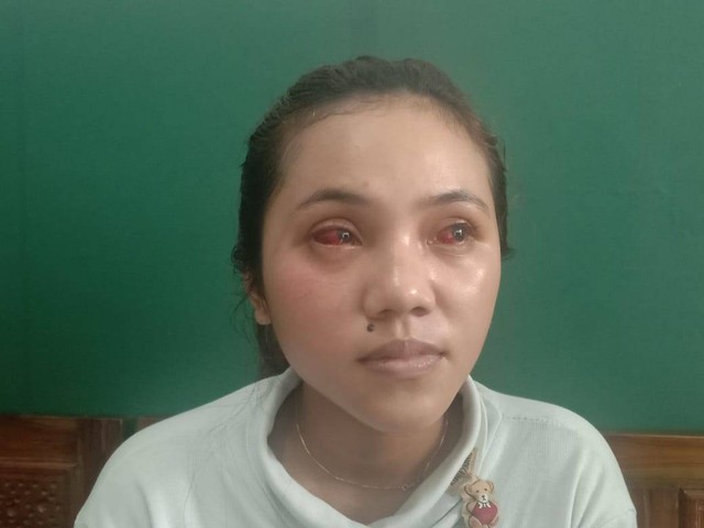 Kevia Naswa, korban tragedi Kanjuruhan yang matanya masih memerah akibat terkena gas air mata dalam tragedi Kanjuruhan. Foto/M Sholeh