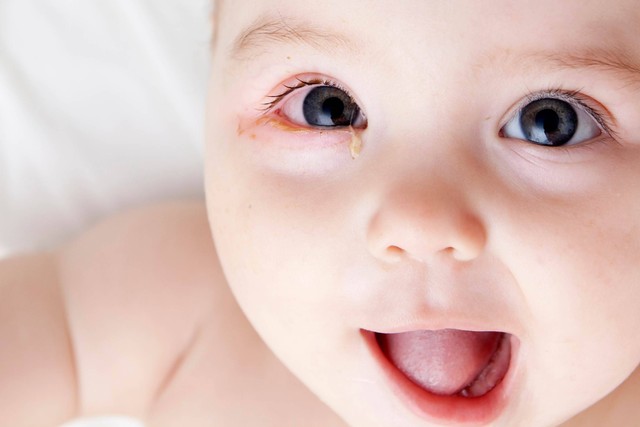 Ilustrasi kemerahan di mata bayi. Foto: Shutterstock