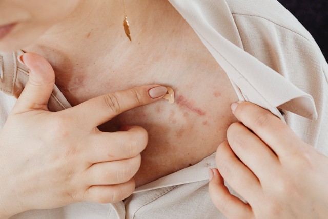 Keloid adalah masalah kulit yang bisa mengganggu penampilan. Foto: Pexels.com