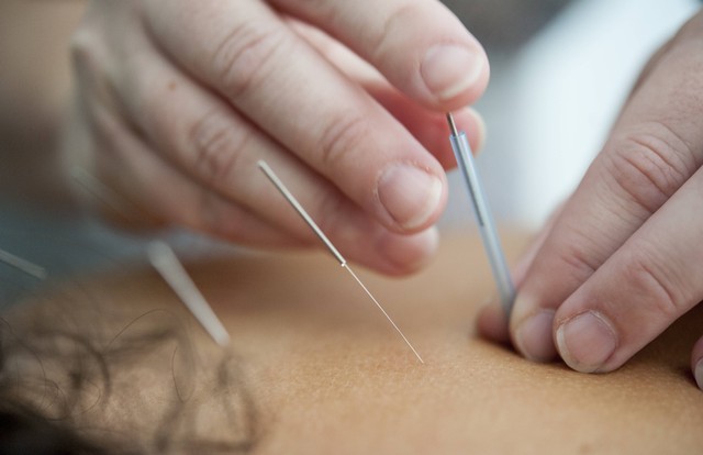 Ilustrasi terapi akupuntur dengan memasukkan jarum tipis ke bagian tubuh tertentu. Foto: Unsplash