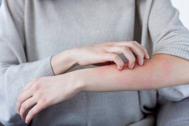 Illustrasi – Dermatitis Atopik | Foto: monstArrr__ (istock) | Sumber: https://www.istockphoto.com/id/foto/wanita-sakit-dengan-alergi-konsep-perawatan-kesehatan-gm1188977393-336490175 