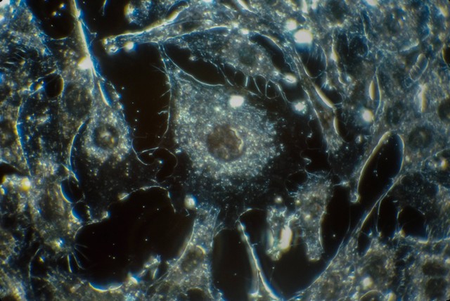 Ilustrasi sel-sel tumor ganas. Foto: Unsplash