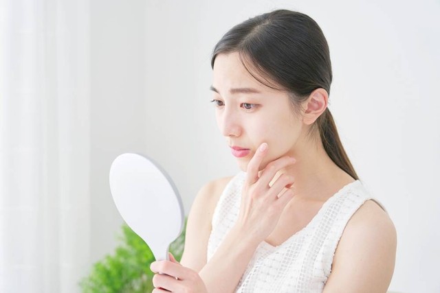 Jerawat yang timbul di berbagai bagian wajah bisa disebabkan oleh bermacam-macam faktor. Foto: Shutterstock