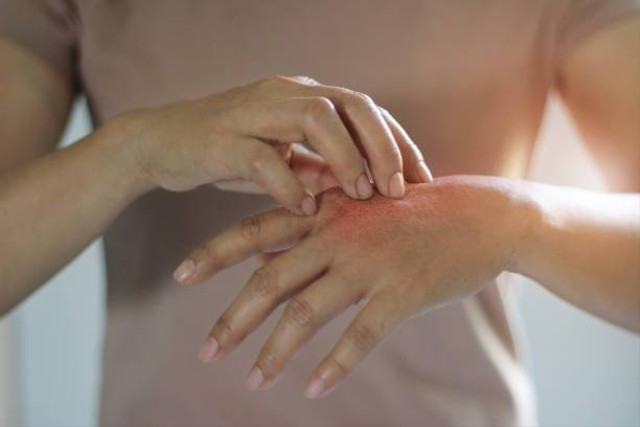 Tangan yang mengalami luka bakar. Sumber: istockphoto.com