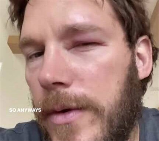 Chris Pratt pamer mata bengkak karena disengat lebah. foto: Instagram Chris Pratt