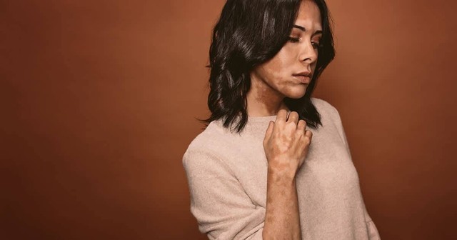 gambar penderita penyakit sopak/vitiligo https://www.shutterstock.com/image-photo/vitiligo-affected-young-woman-studio-female-1012695898