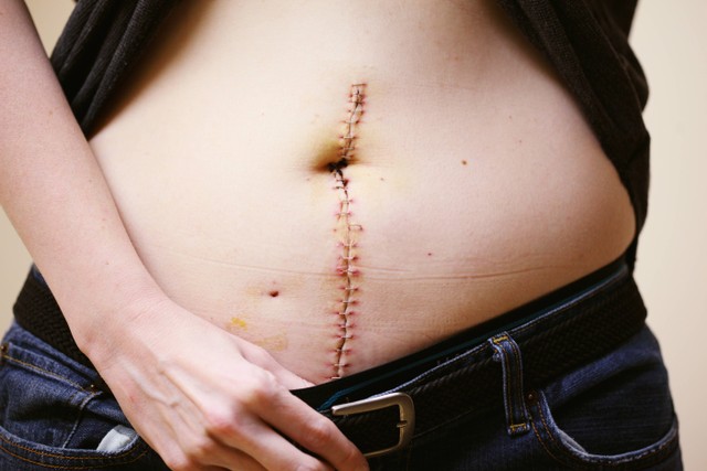 Ilustrasi luka operasi caesar bisa terbuka apabila mengalami komplikasi selama masa penyembuhan. Foto: Pexels