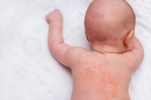 Ilustrasi bayi terkena dermatitis. Foto: Shutterstock
