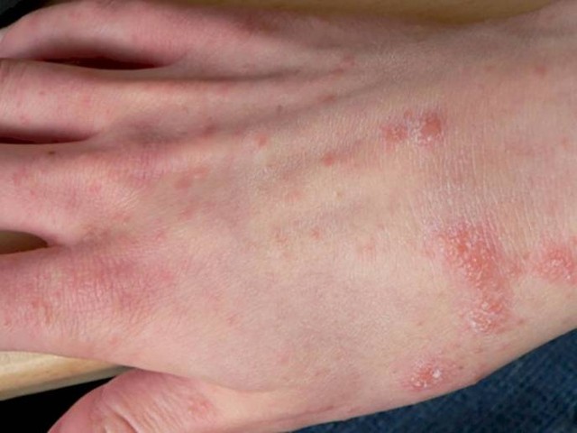 Ilustrasi scabies. Foto: medicalnewstoday