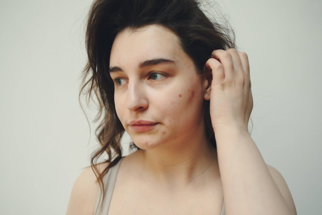 Cara Merawat Kulit Sensitif. Foto: Pexels