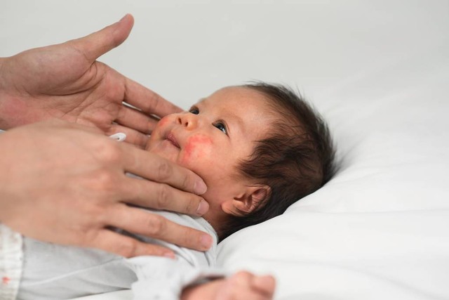 Ilustrasi bintik merah di wajah bayi. Foto: Shutterstock.com