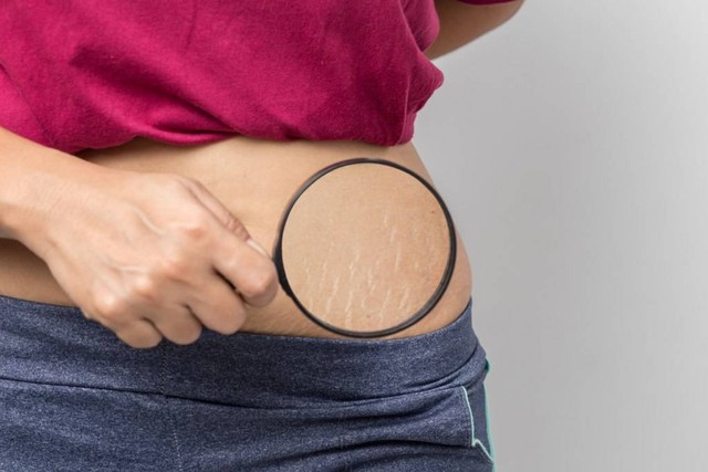 Stretch mark atau guratan peregangan yang adala kondisi peregangan yang disebabkan oleh rusaknya jaringan elastis pada lapisan kulit dalam. Foto: Shutterstock.com