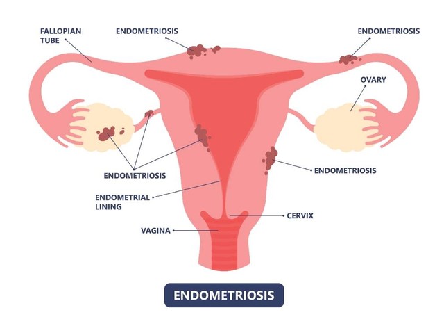 Ilustrasi endometriosis pada perempuan. Foto: Pepermpron/Shutterstock