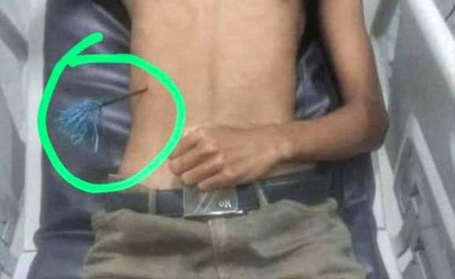 Keterangan foto:Korban  Federikus Sadin (17 tahun) saat dirawat di RSUD Maumere, Jumat (31/3/2023). Foto:istimewa.