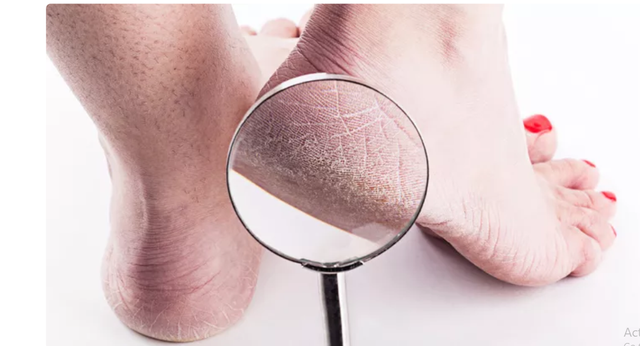 ilustrasi gambar cara mengatasi kaki pecah-pecah | Foto: Google chrome.com