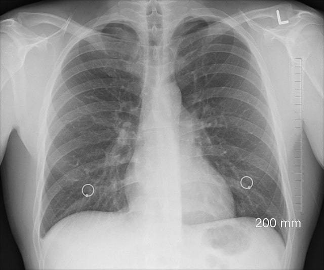 Contoh gambar paru-paru manusia. Sumber foto: Pixabay.com