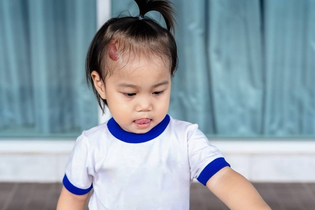 Tanda lahir anak/bayi. Foto: Shutter Stock