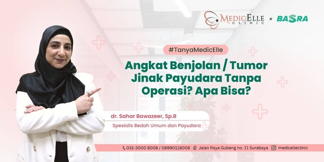 Angkat Benjolan/Tumor Jinak Payudara Tanpa Operasi? Apa Bisa?