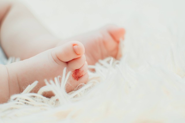 Tanda lahir hemangioma pada bayi. Foto: komokvm/Shutterstock