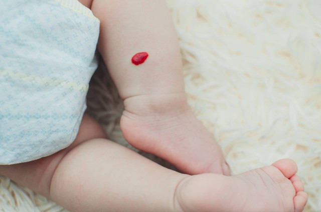 Tanda lahir hemangioma pada bayi. Foto: komokvm/Shutterstock