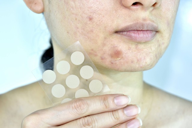 Ilustrasi acne patch untuk jerawat. Foto: Shutterstock