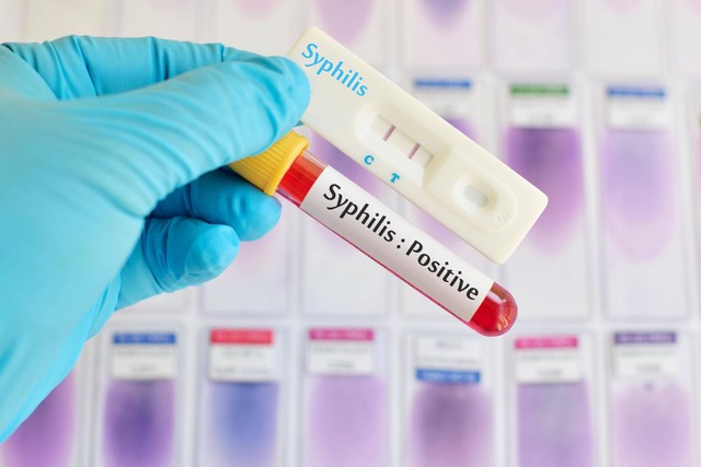 Kasus Sifilis Meningkat secara Global, Kecepatannya Mengkhawatirkan