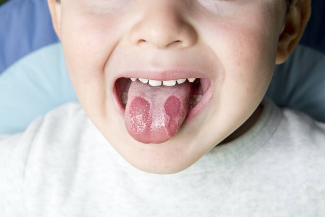 Geographic tongue pada anak. Foto: Shutterstock