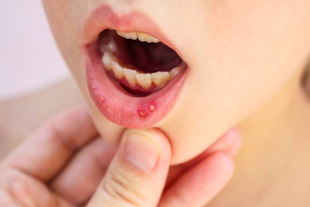 Ilustrasi sariawan pada anak. Foto: Victoria 1/Shutterstock
