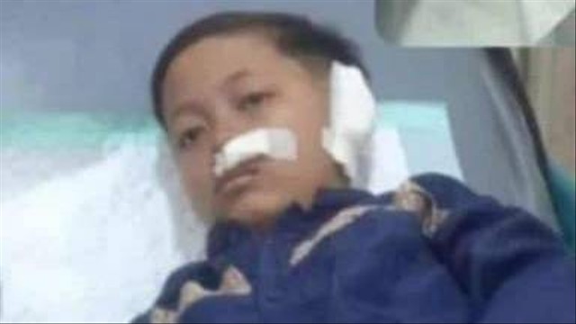 Khoirul (13 tahun) bocah asal Kecamatan Bugul Kidul, Kota Pasuruan, daun telinganya putus akibat digigit oleh temannya. Foto: Dok. Istimewa