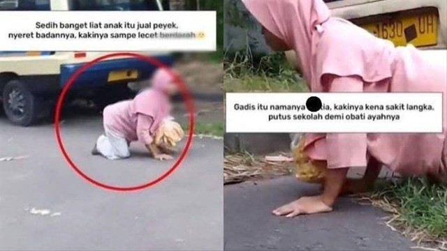 Polda Jatim Bantu Operasi Cyntia Penjual Peyek Sambil Merangkak yang Viral