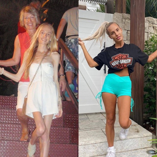 Kisah perempuan yang sembuh dari anoreksia. Foto: Instagram/@gemswalker