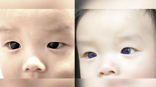 Mata balita berusia 6 bulan berubah warna dari coklat menjadi biru gara-gara minum obat antivirus favipiravir untuk covid-19. Foto: Frontiers in Pediatrics 