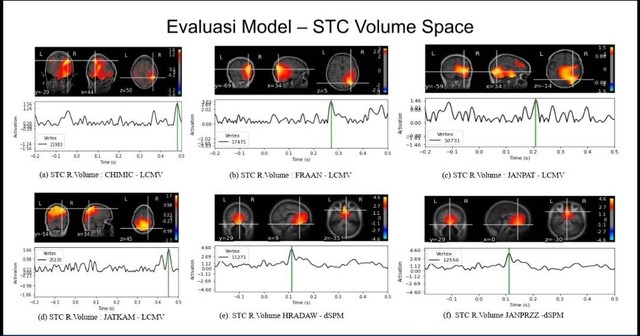 Hasil implementasi STCS dan MRI dalam menentukan titik koordinat bagian otak yang menyebabkan epilepsi pada beberapa dataset yang digunakan.