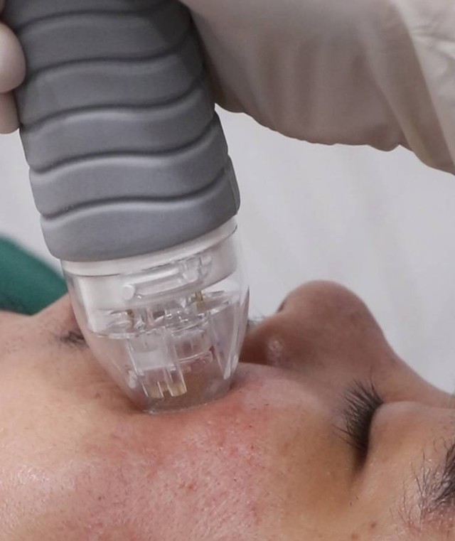 Treatment MD RF Microneedling 3D.