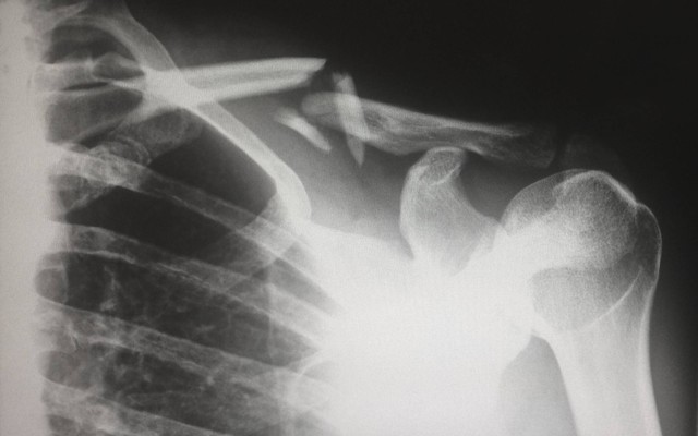 Ilustrasi osteoporosis. Sumber: Unsplash / Harlie Raethel