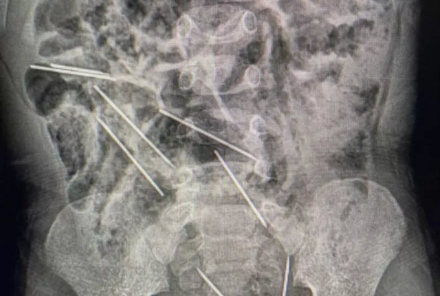 X-ray jarum yang bersarang di dalam tubuh balita.  Foto: San Martin Regional Government