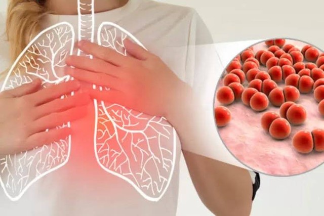 Ilustrasi pneumonia. Foto: Pixabay
