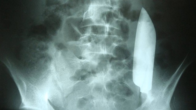 Mata pisau tertinggal di perut seorang pria di Nepal. Foto: Nepal et al/Cureus