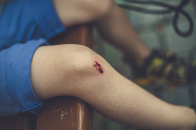 Ilustrasi cara menghilangkan bekas luka. Sumber: Unsplash/Geofany J.