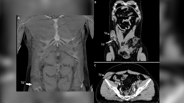 Pemindaian pada tubuh pria tersebut menunjukkan bahwa testis kanannya, yang ditandai huruf "Td" pada gambar di atas, telah mengalami dislokasi ke perutnya. Foto: BMJ Case Reports