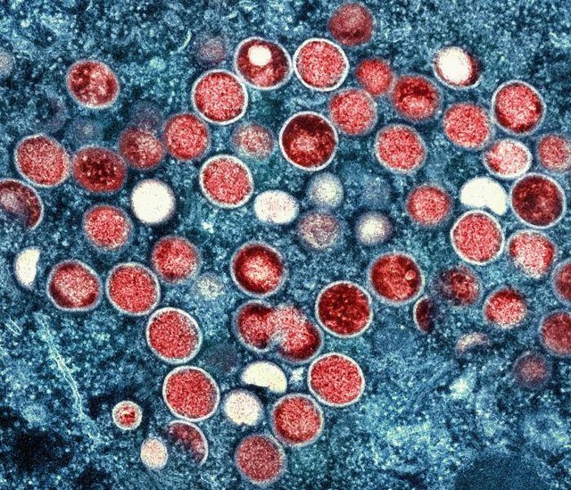 Gambar virus cacar monyet (merah) yang ditemukan dalam sel terinfeksi (biru) pada citra mikroskop elektron. Foto : CDC.gov : By National Institute of Allergy and Infectious Diseases (NIAID)